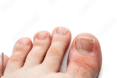 Obraz na płótnie Cracked nails of the toes isolated on white, closeup shot w salonie