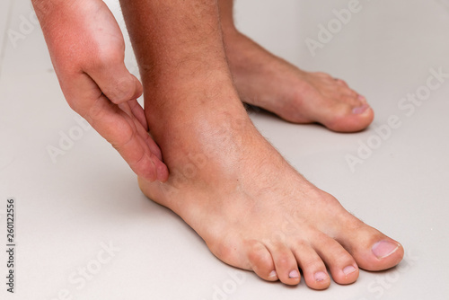 Obraz na plátně swollen leg after ankle sprain