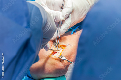Canvas Print Group of orthopedic surgeons performing surgery on a patient arm