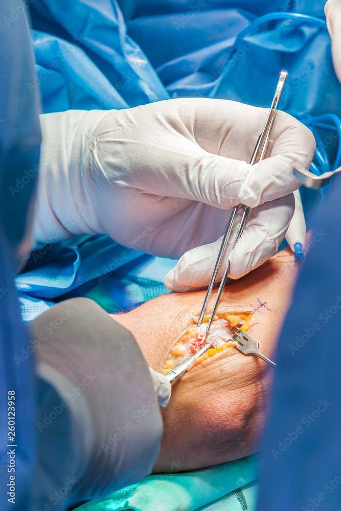 Group of orthopedic surgeons performing surgery on a patient arm Group of orthopedic surgeons performing surgery on a patient arm
