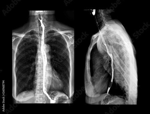 Esophagram or Barium swallow AP and Lateral view is an X-ray of the esophagus ,The patient drinks a liquid that contains barium .The liquid coats the esophagus and X-rays are taken. photo