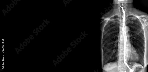 Tableau sur toile Esophagram or Barium swallow AP view is an X-ray of the esophagus ,The patient drinks a liquid that contains barium