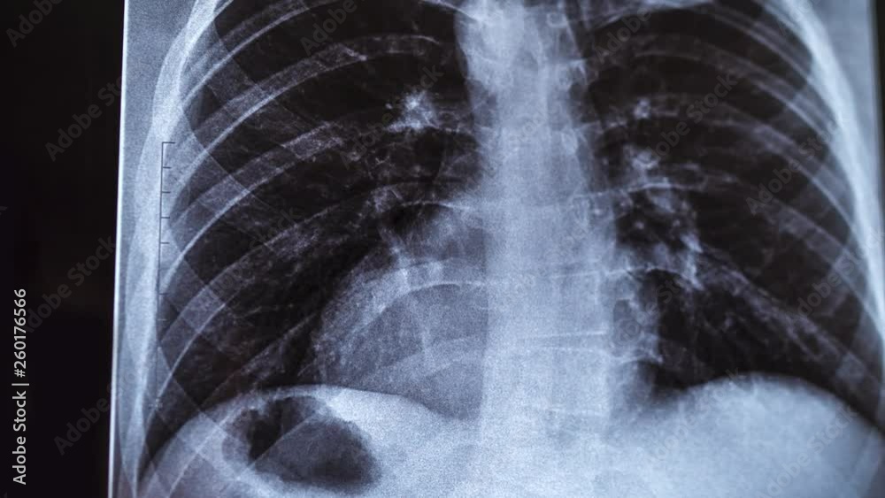 Chest X-ray image for physicians examination Chest X-ray image for physicians examination