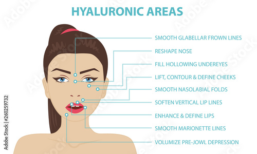 hyaluronic acid facial injection areas