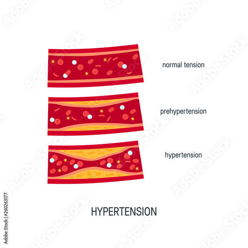 Blood pressure concept in flat style, vector