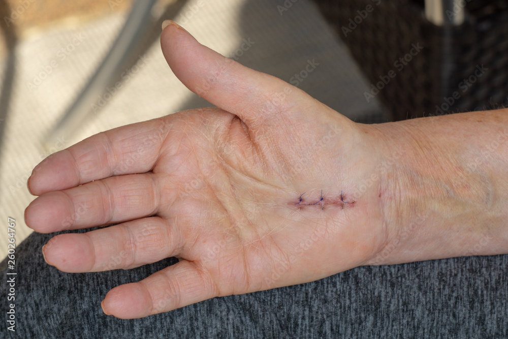 Hand with scar from a carpal tunnel syndrome operation Hand with scar from a carpal tunnel syndrome operation