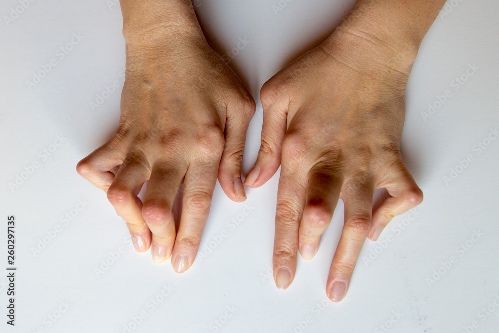 Young woman's hands deformed from Rheumatoid Arthritis.