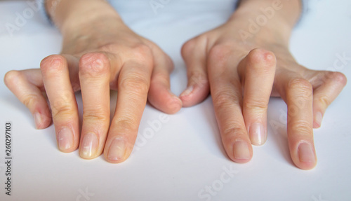 Young woman s hands deformed from Rheumatoid Arthritis.