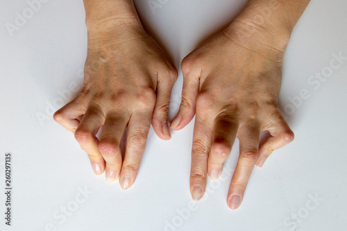Obraz na płótnie Young woman's hands deformed from Rheumatoid Arthritis. w salonie