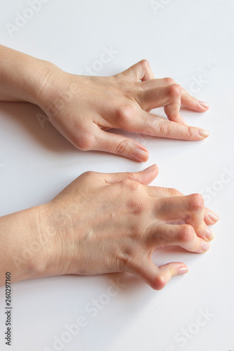 Young woman's hands deformed from Rheumatoid Arthritis.