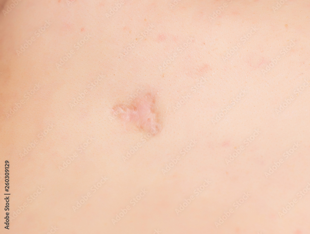 Large scar and scar on the patient's skin after removing an inflamed pimple, close-up, professional