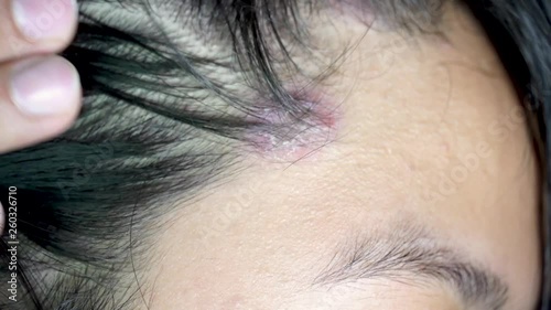 Skin diseases, on the scalp ,Woman with dandruff in her dark hair