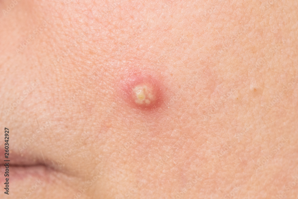 Closeup view of big ugly pimple on skin of face of woman. Horizontal color photography,