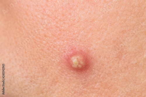 Closeup view of big ugly pimple on skin of face of woman. Horizontal color photography, photo