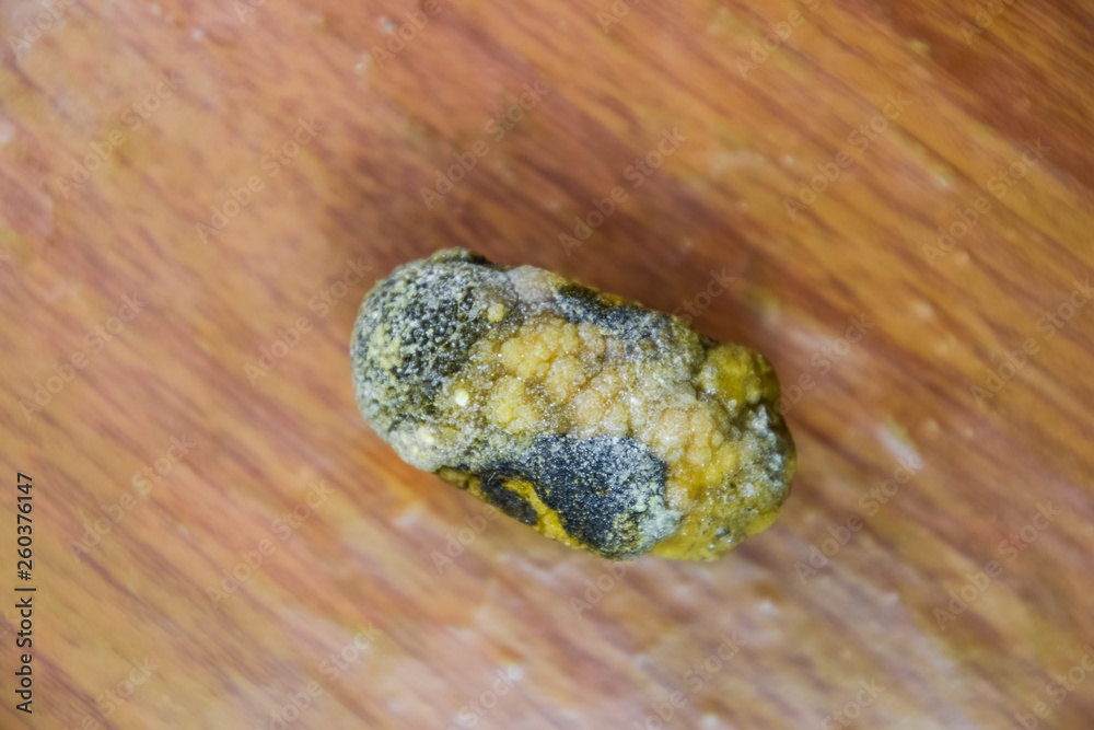Large gallstone, Gall bladder stone. The result of gallstones Large gallstone, Gall bladder stone. The result of gallstones