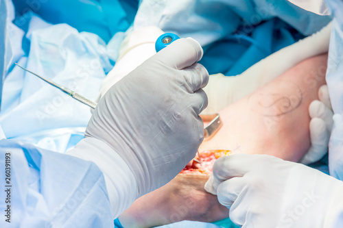 Group of orthopedic surgeons performing surgery on a patient arm