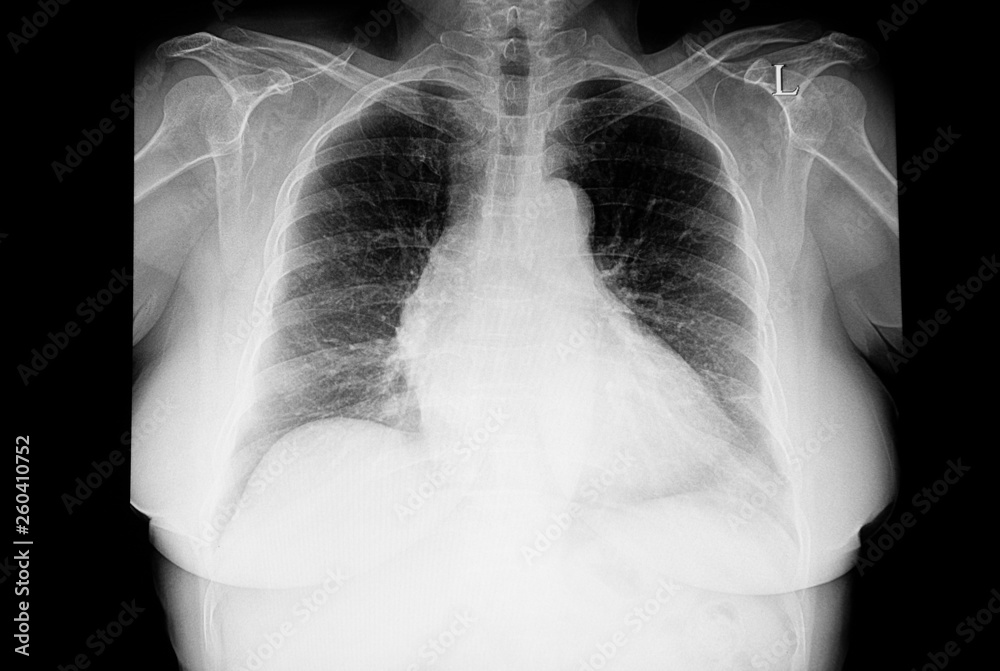 chest xray of the patient with cardiomegaly chest xray of the patient with cardiomegaly