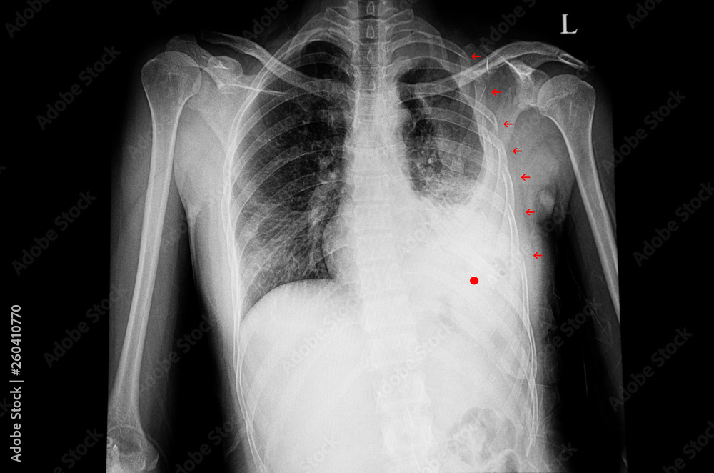 Hemothorax xray
