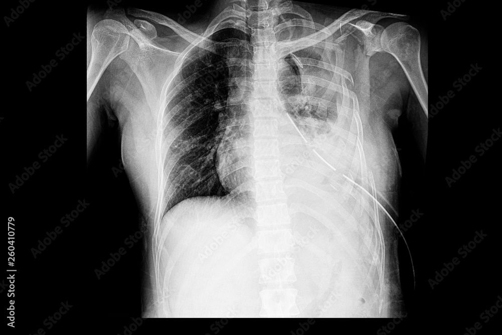 Stockfoto chest xray of the pateint with multiple rib fractures with