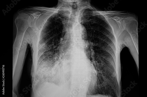chest xray film of the patient with pneumonia right lower lung. Covid-19 pneumonia. Covid lung infection. photo