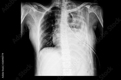 chest xray of the pateint with multiple rib fractures with hemothorax