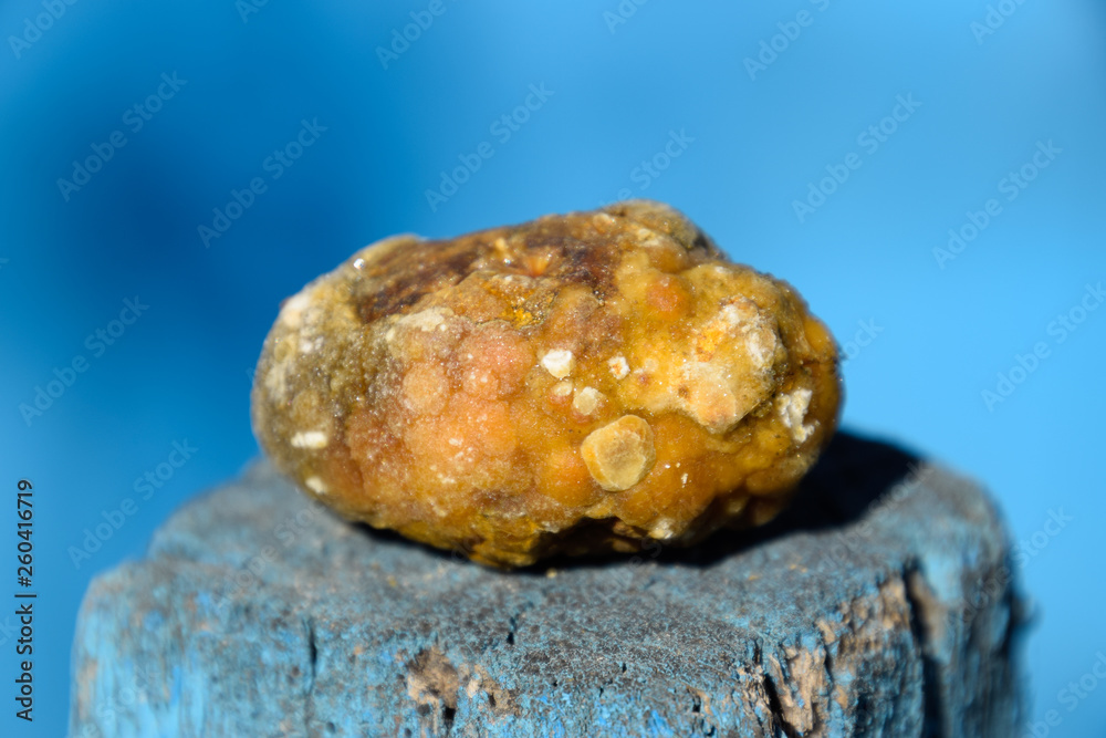 Gall bladder stone. Calculus of heterogeneous composition Gall bladder stone. Calculus of heterogeneous composition