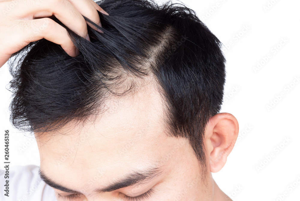 Young man serious hair loss problem for health care medical and shampoo product concept Young man serious hair loss problem for health care medical and shampoo product concept