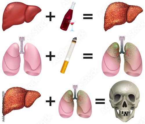 Alcohol and Smoking linked to premature Death in many Cancers. Human organs Liver, Lungs, Skull