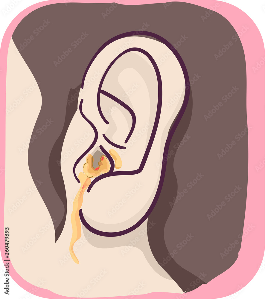 Ear Symptoms Fluid Leak Infection Illustration