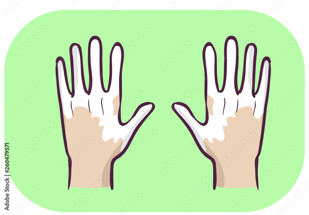 Hands Symptom Loss Of Pigment In Skin Illustration Hands Symptom Loss Of Pigment In Skin Illustration
