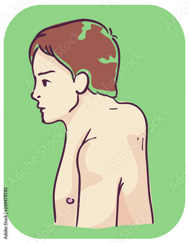 Man Symptom Buffalo Hump Illustration