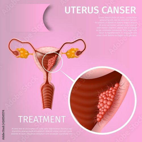 Uterine Cancer. Chart with Cancerous Tumor Cells