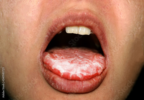 Thrush in the tongue of the child. Candida photo