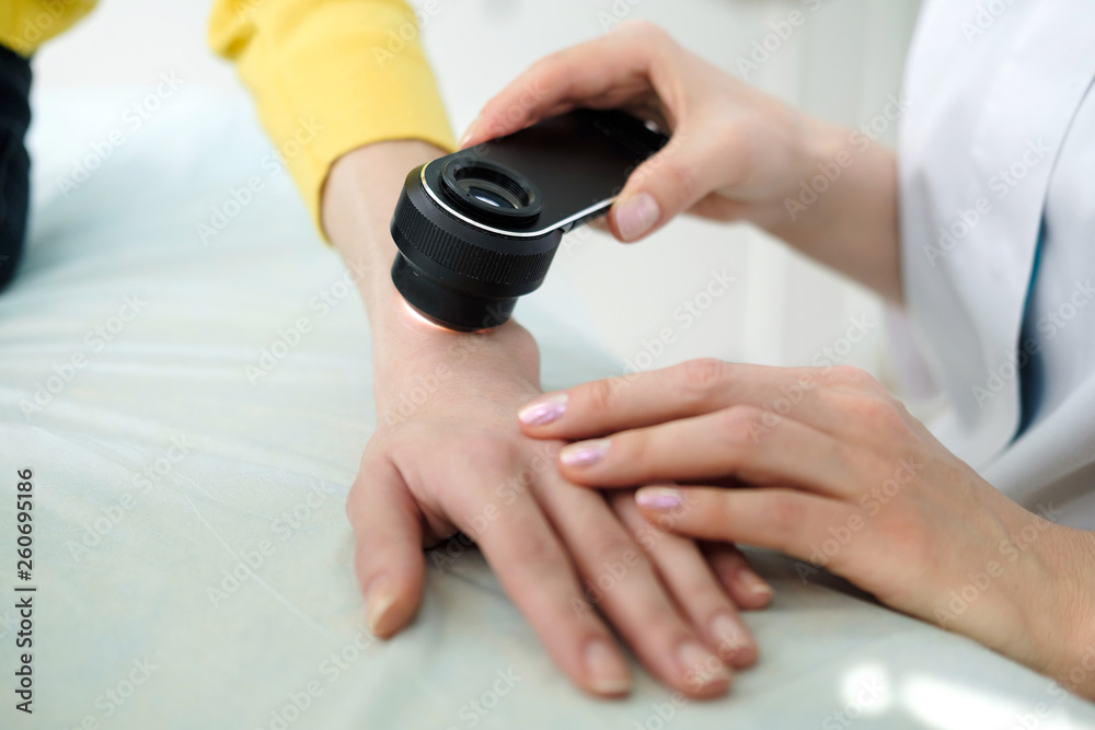 Female dermatologist using a professional dermatoscope while doing skin examination, Checking benign moles on hand. Dermatologist examining birthmarks and moles on a female patient. Dermatology Clinic Female dermatologist using a professional dermatoscope while doing skin examination, Checking benign moles on hand. Dermatologist examining birthmarks and moles on a female patient. Dermatology Clinic