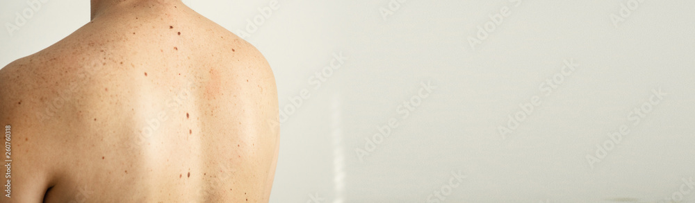 Close up detail of the bare skin on a man back with scattered moles and freckles. Checking benign moles. Sun effect on skin. Birthmarks on skin Close up detail of the bare skin on a man back with scattered moles and freckles. Checking benign moles. Sun effect on skin. Birthmarks on skin