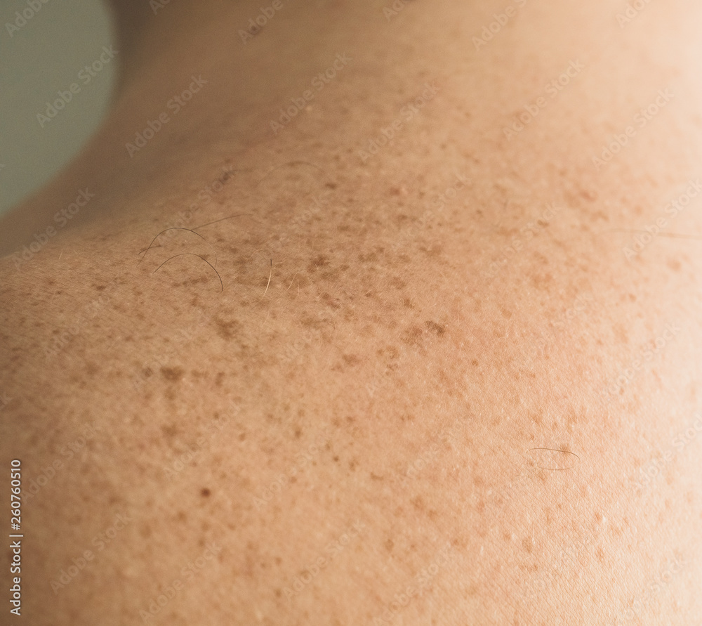 Close up detail of the bare skin on a man back with scattered moles and freckles. Checking benign moles. Sun effect on skin. Birthmarks on skin Close up detail of the bare skin on a man back with scattered moles and freckles. Checking benign moles. Sun effect on skin. Birthmarks on skin