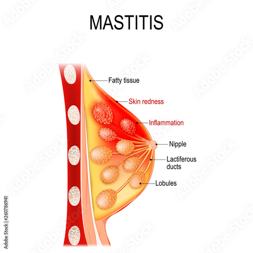 Mastitis. Cross-section of the mammary gland with inflammation of the breast (abscess formation). photo