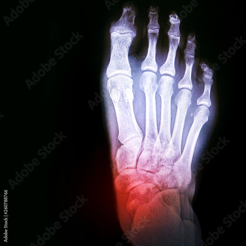 Dislocation of the ankle or arthritis of the joint. X-ray of the foot with the designation of the sore spot