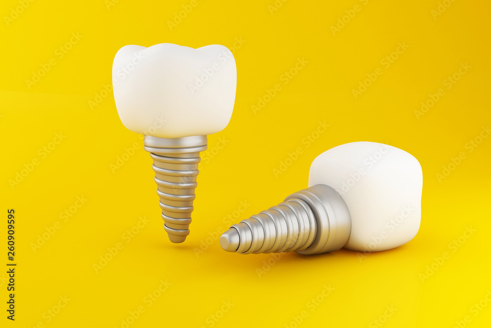 3D Dental tooth implant.