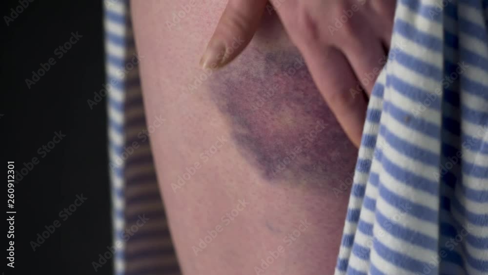 The Female With A Bruise