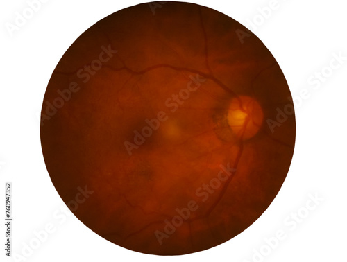 Retina of diabetes , diabates retinopathy,photo Medical Retina Abnormal isolated on white background.Saved with clipping path