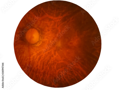Retina of diabetes , diabates retinopathy,photo Medical Retina Abnormal isolated on white background.Saved with clipping path photo