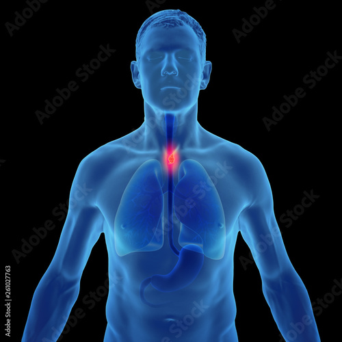 3D Illustration of esophageal cancer in the human male