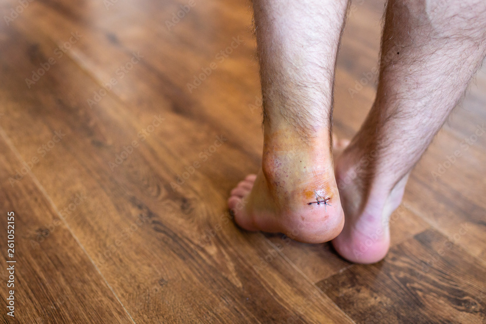 Injured and swollen ankle with stitched up wound isolated against wooden background Injured and swollen ankle with stitched up wound isolated against wooden background