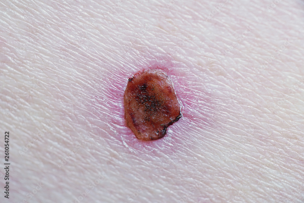 healing-wound-with-scab-after-basal-cell-skin-cancer-laser-treatment