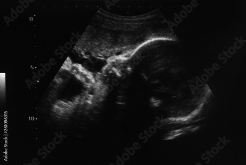 Ultrasound photo of unborn baby in mother's womb, closeup view photo