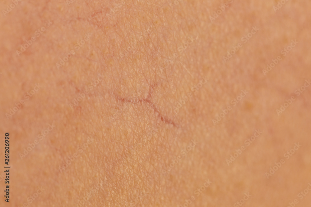 Ski with dilated capillaries ad red spots Ski with dilated capillaries ad red spots