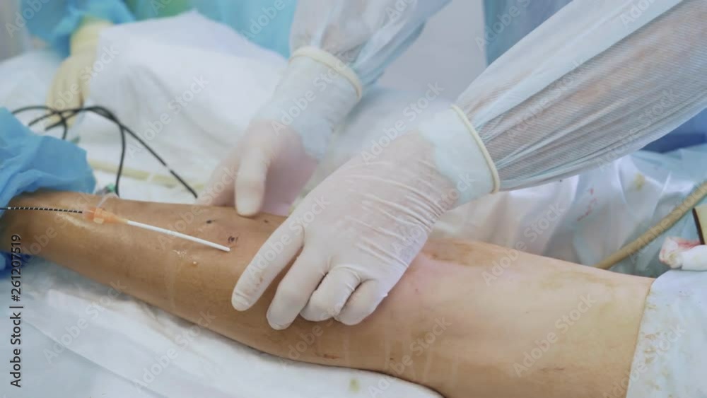 Close-up hands of doctor in sterile gloves makes surgery to remove varicose veins on patient leg Close-up hands of doctor in sterile gloves makes surgery to remove varicose veins on patient leg