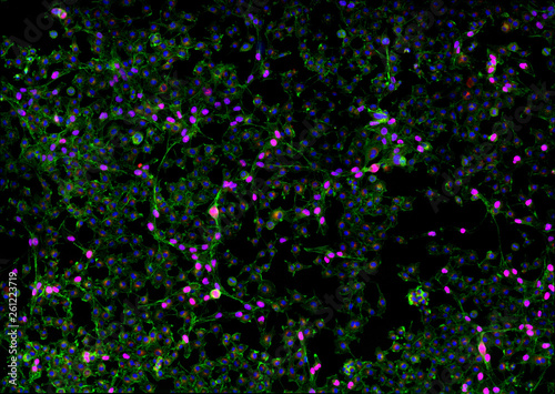 Real fluorescence microscopic view of cancer cells - human melanoma