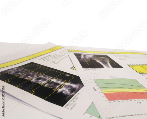 Soft and blurry image Woman's hip bone mass image The graph has a standard point below Therefore diagnosed with osteoporosis  photo